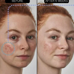 10% Azelaic Acid Serum, 30 ml